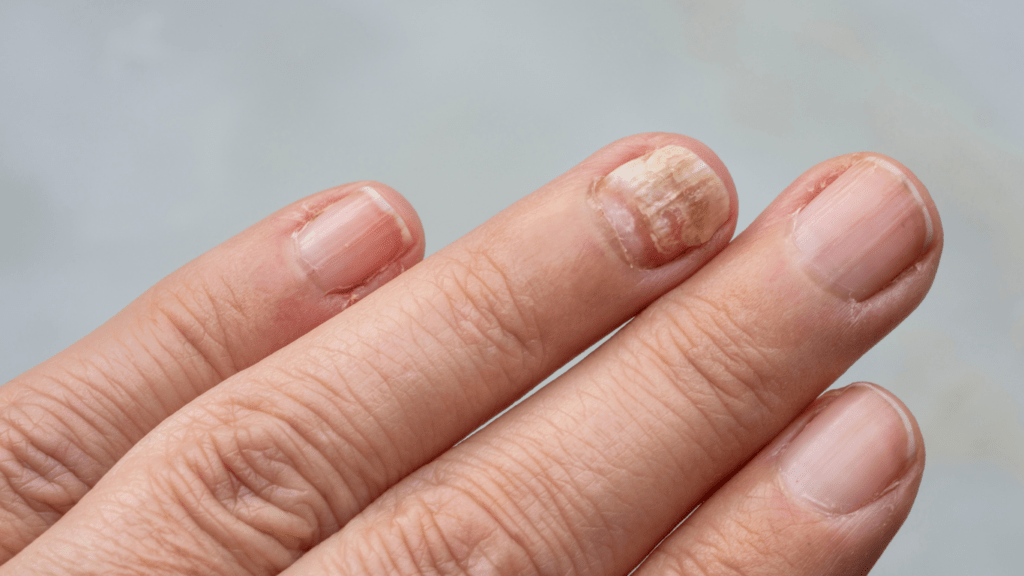 Damaged Nails